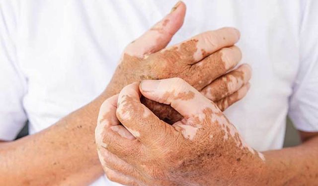Stres ve travmalar vitiligo hastalığını tetikliyor
